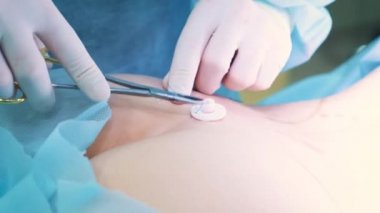 cerrah ameliyat odasında bir işlem gerçekleştirir. Liposuction mı.