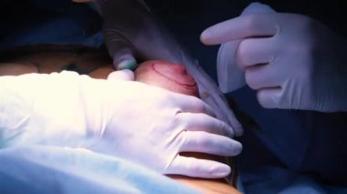 Estetik göğüs büyütme operasyonu sırasında implant giriş hastalar göğüs içine. Cerrah deri altında kadın meme silikon implant ekler. Göğüsleri artırır