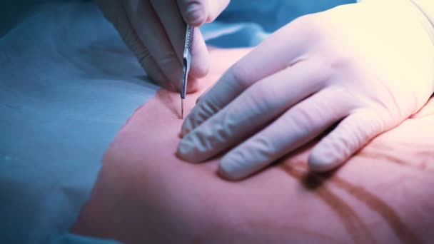 L'introduction de l'implant dans la poitrine des patients pendant l'augmentation mammaire de la chirurgie plastique. Le chirurgien insère sous la peau un implant en silicone du sein féminin. Augmente les seins — Video