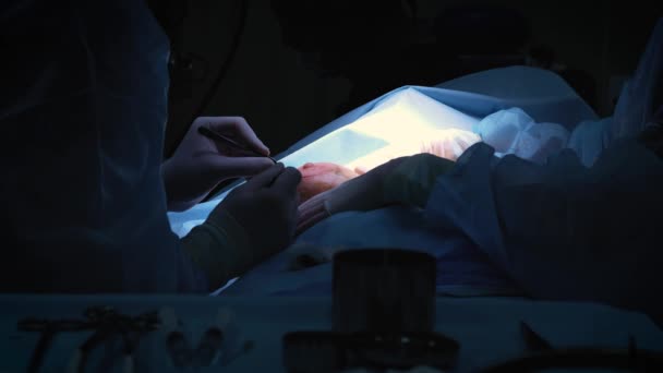 L'introduction de l'implant dans la poitrine des patients pendant l'augmentation mammaire de la chirurgie plastique. Le chirurgien insère sous la peau un implant en silicone du sein féminin. Augmente les seins — Video