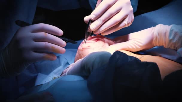 Введение имплантата в грудь пациента во время пластической операции по увеличению груди. Хирург вставляет под кожу силиконовый имплантат женской груди. Увеличивает сиськи — стоковое видео