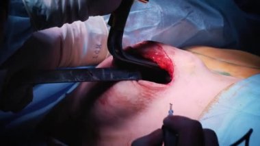 Estetik göğüs büyütme operasyonu sırasında implant giriş hastalar göğüs içine. Cerrah deri altında kadın meme silikon implant ekler. Göğüsleri artırır