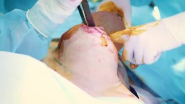 Estetik göğüs büyütme operasyonu sırasında implant giriş hastalar göğüs içine. Cerrah deri altında kadın meme silikon implant ekler. Göğüsleri artırır