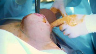 Estetik göğüs büyütme operasyonu sırasında implant giriş hastalar göğüs içine. Profesyonel bir cerrah bir kadının göğüsleri artırır. İmplantlar ekler. Kadın güzelliğinin