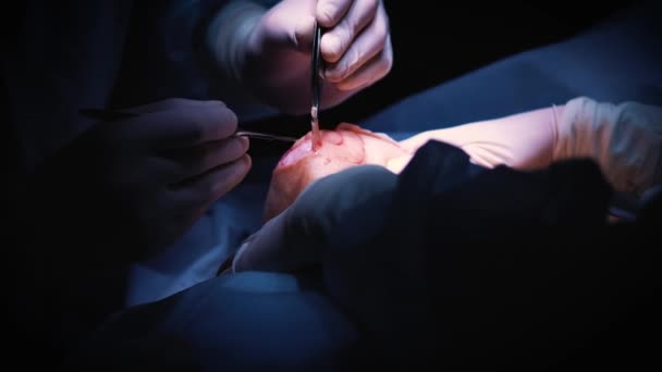 De invoering van het implantaat in de borst van patiënten tijdens de vergroting van de borst van de plastische chirurgie. De chirurg wordt ingevoegd onder de huid een siliconen implantaat van de vrouwelijke borst. Verhoogt tieten — Stockvideo