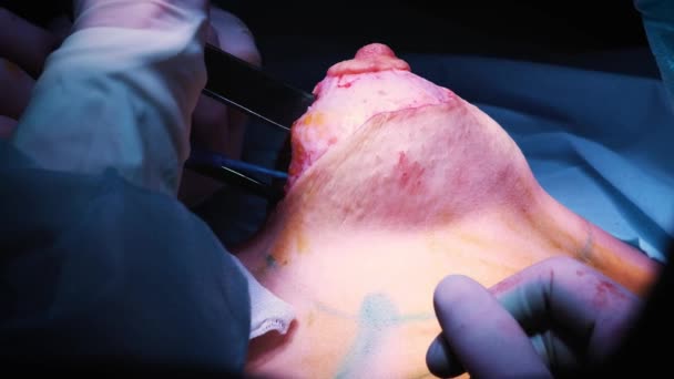 豊胸整形手術中に患者の胸にインプラントの導入。外科医は、皮膚の下に女性の胸のシリコンイン プラントを挿入します。おっぱいが増加します。 — ストック動画