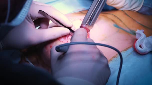 在整形外科隆胸术中引入植入病人胸部。外科医生在皮肤之下插入女性乳房的硅胶植入物。增加乳房 — 图库视频影像
