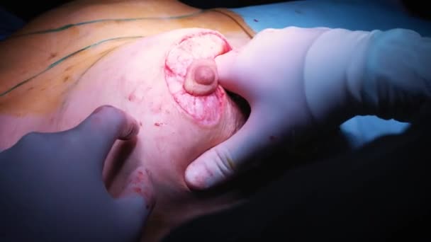 豊胸整形手術中に患者の胸にインプラントの導入。外科医は、皮膚の下に女性の胸のシリコンイン プラントを挿入します。おっぱいが増加します。 — ストック動画