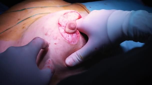 The introduction of the implant into the patients chest during plastic surgery breast augmentation. The surgeon inserts under the skin a silicone implant of the female breast. Increases tits — Stock Video