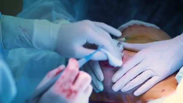 L'introduction de l'implant dans la poitrine des patients pendant l'augmentation mammaire de la chirurgie plastique. Le chirurgien insère sous la peau un implant en silicone du sein féminin. Augmente les seins — Video
