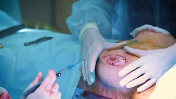 La introducción del implante en el tórax de las pacientes durante la cirugía plástica de aumento de mama. El cirujano inserta debajo de la piel un implante de silicona de la mama femenina. Aumenta las tetas — Vídeo de stock