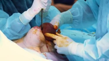 Estetik göğüs büyütme operasyonu sırasında implant giriş hastalar göğüs içine. Profesyonel bir cerrah bir kadının göğüsleri artırır. İmplantlar ekler. Kadın güzelliğinin