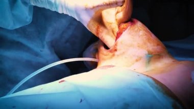 Estetik göğüs büyütme operasyonu sırasında implant giriş hastalar göğüs içine. Profesyonel bir cerrah bir kadının göğüsleri artırır. İmplantlar ekler. Kadın güzelliğinin