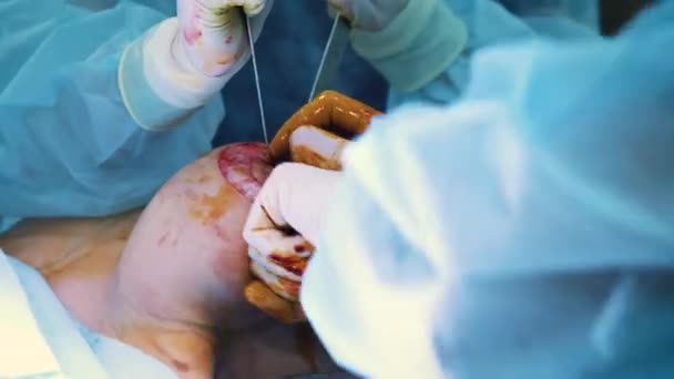 Introdução do implante no tórax das pacientes durante a cirurgia plástica aumento mamário. Um cirurgião profissional aumenta os seios de uma mulher. Insere implantes. Beleza feminina — Vídeo de Stock