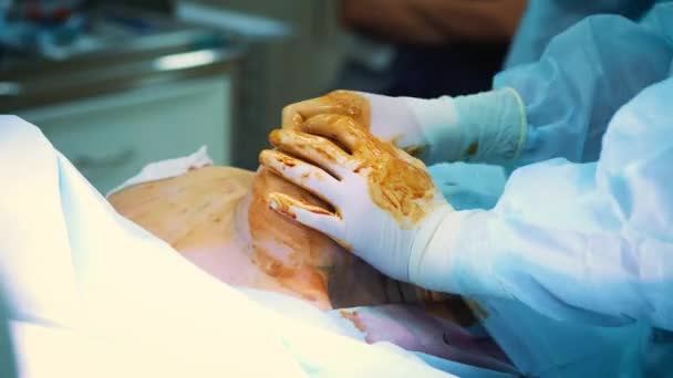 Την εισαγωγή του εμφυτεύματος στο στήθος τους ασθενείς κατά τη πλαστική χειρουργική μαστών. Επαγγελματική χειρουργός αυξάνει ένα γυναικείο στήθος. Εισάγει τα εμφυτεύματα. Γυναικεία ομορφιά — Αρχείο Βίντεο