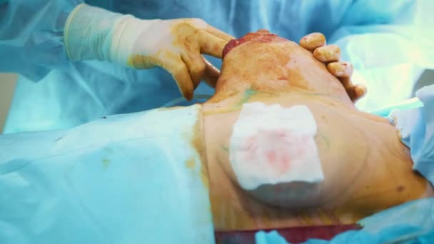 L'introduction de l'implant dans la poitrine des patients pendant l'augmentation mammaire de la chirurgie plastique. Un chirurgien professionnel augmente les seins d'une femme. Insère des implants. Beauté féminine — Video