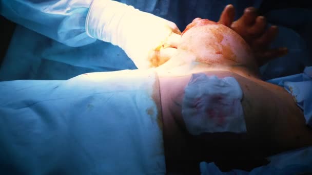 La introducción del implante en el tórax de las pacientes durante la cirugía plástica de aumento de mama. Un cirujano profesional aumenta los senos de una mujer. Inserta implantes. Belleza femenina — Vídeo de stock
