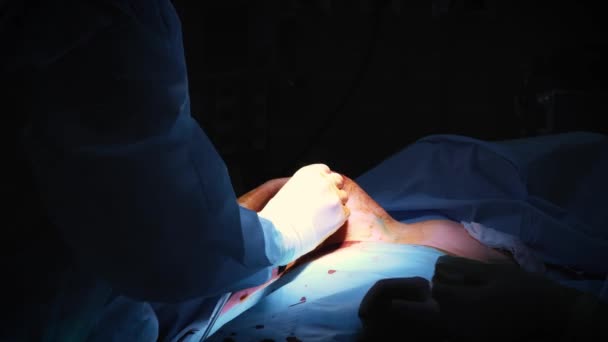 L'introduction de l'implant dans la poitrine des patients pendant l'augmentation mammaire de la chirurgie plastique. Le chirurgien insère sous la peau un implant en silicone du sein féminin. Augmente les seins — Video