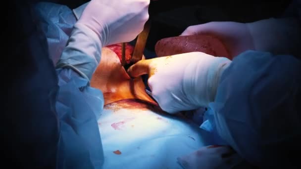 在整形外科隆胸术中引入植入病人胸部。外科医生在皮肤之下插入女性乳房的硅胶植入物。增加乳房 — 图库视频影像