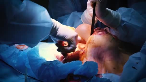 The introduction of the implant into the patients chest during plastic surgery breast augmentation. The surgeon inserts under the skin a silicone implant of the female breast. Increases tits — Stock Video