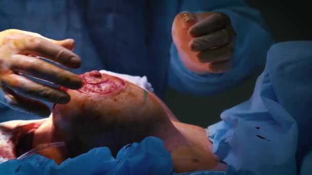 Introdução do implante no tórax das pacientes durante a cirurgia plástica aumento mamário. O cirurgião insere sob a pele um implante de silicone da mama feminina. Aumenta mamas — Vídeo de Stock