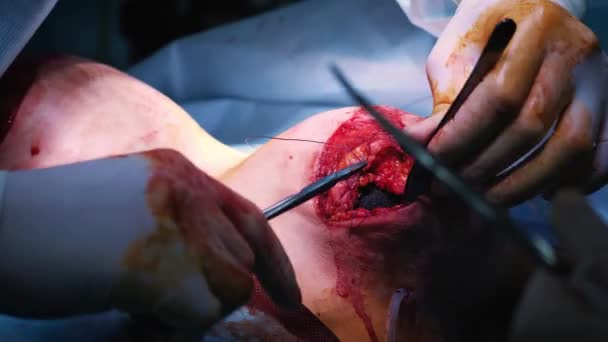 La introducción del implante en el tórax de las pacientes durante la cirugía plástica de aumento de mama. El cirujano inserta debajo de la piel un implante de silicona de la mama femenina. Aumenta las tetas — Vídeo de stock