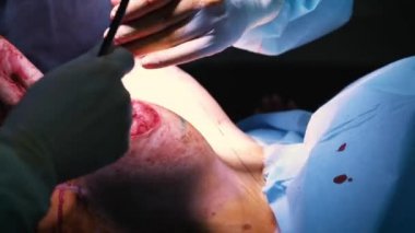 Estetik göğüs büyütme operasyonu sırasında implant giriş hastalar göğüs içine. Cerrah deri altında kadın meme silikon implant ekler. Göğüsleri artırır