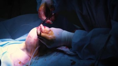 Estetik göğüs büyütme operasyonu sırasında implant giriş hastalar göğüs içine. Cerrah deri altında kadın meme silikon implant ekler. Göğüsleri artırır