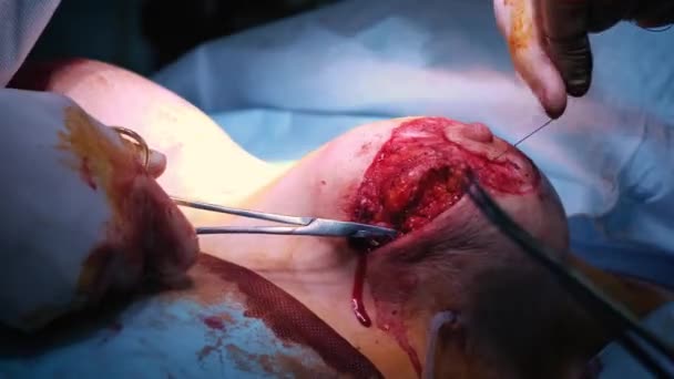Die Einführung des Implantats in die Brust des Patienten während der Brustvergrößerung durch plastische Chirurgie. Der Chirurg setzt ein Silikonimplantat der weiblichen Brust unter die Haut. erhöht Titten — Stockvideo