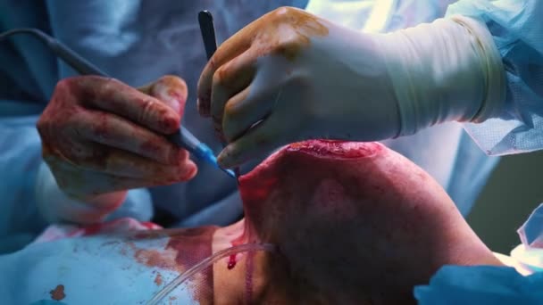 Införsel av implantatet patienter bröstet under plastikkirurgi bröstförstoring. Kirurgen skär under huden ett silikon implantat av kvinnliga bröst. Ökar tuttar — Stockvideo