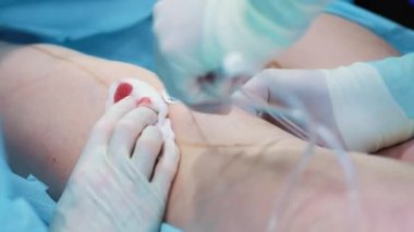Ameliyathane: liposuction cerrahi için hazırlıklar. bir takım cerrah liposuction işlemi için bir kız var. Cerrah bir kanül çalışır.