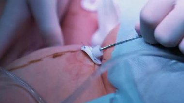 Ameliyathane: liposuction cerrahi için hazırlıklar. bir takım cerrah liposuction işlemi için bir kız var. Cerrah bir kanül çalışır.