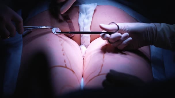 Salle d'opération : préparations pour la chirurgie par liposuccion. une équipe de chirurgiens fait l'opération de liposuccion à une fille. Le chirurgien travaille comme une canule . — Video