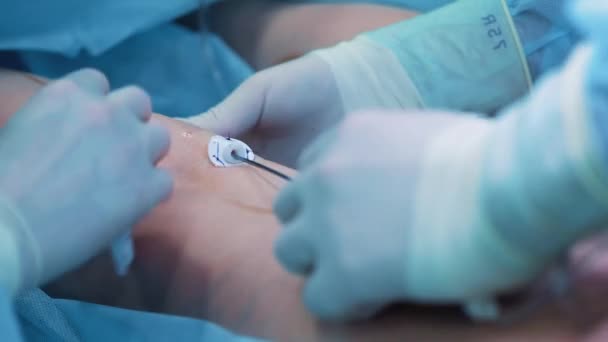 Salle d'opération : préparations pour la chirurgie par liposuccion. une équipe de chirurgiens fait l'opération de liposuccion à une fille. Le chirurgien travaille comme une canule . — Video