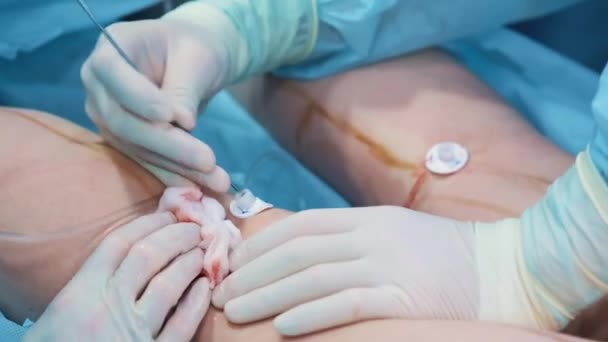 Operační sál: přípravy na liposukce. tým z chirurgové dělat operace liposukce s dívkou. Lékař pracuje jako kanyla. — Stock video