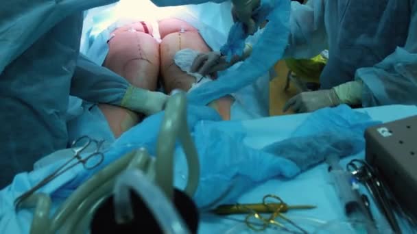 Χειρουργός και χειρουργική ομάδα εκτέλεση πλαστικής χειρουργικής επέμβασης στα στήθη σε λειτουργικό δωμάτιο νοσοκομείου. Αύξηση του μαστού. Mammoplasty. Διεύρυνση του μαστού. Η λιποαναρρόφηση. Περίθαλψης έκτακτης ανάγκης. Χειρουργική λεπτομέρεια. — Αρχείο Βίντεο