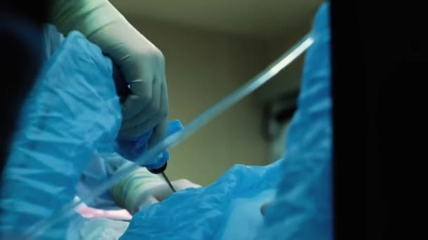 Χειρουργός και χειρουργική ομάδα εκτέλεση πλαστικής χειρουργικής επέμβασης στα στήθη σε λειτουργικό δωμάτιο νοσοκομείου. Αύξηση του μαστού. Mammoplasty. Διεύρυνση του μαστού. Η λιποαναρρόφηση. Περίθαλψης έκτακτης ανάγκης. Χειρουργική λεπτομέρεια. — Αρχείο Βίντεο