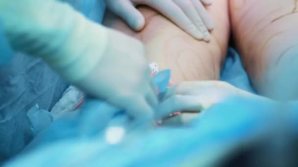 Operationssalen: förberedelserna för fettsugning kirurgi. ett team av kirurger gör driften av fettsugning till en flicka. Kirurgen fungerar som en kanyl. — Stockvideo