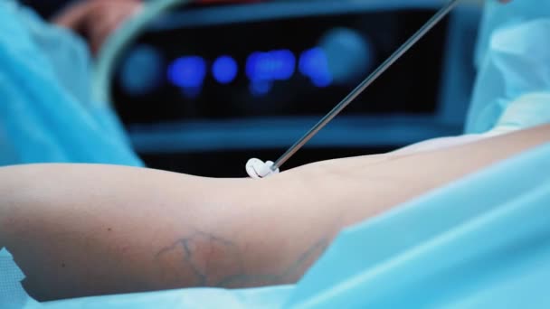 Ameliyathane: liposuction cerrahi için hazırlıklar. bir takım cerrah liposuction işlemi için bir kız var. Cerrah bir kanül çalışır. — Stok video