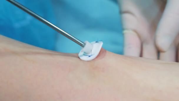 Χειρουργείο: προετοιμασίες για τη χειρουργική επέμβαση liposuction. μια ομάδα χειρουργών κάνει τη λειτουργία της λιποαναρρόφησης για ένα κορίτσι. Ο χειρουργός εργάζεται ως κάνουλα. — Αρχείο Βίντεο