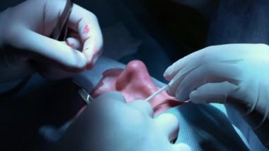 Cerrah bir operasyonu göze, yakın çekim. Gözleri ve göz düzeltme. Doktor Blefaroplasti yapar. Ameliyathane işlem. Neşter ve kelepçe yakın öğrenci çok.