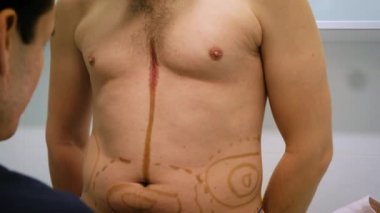 Bir plastik cerrah liposuction ve liposculpture işlemi için bir biçimlendirme çizer. Bir hasta bir adamdır, bir güzellik mans