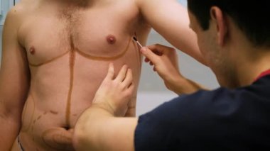 Bir plastik cerrah liposuction ve liposculpture işlemi için bir biçimlendirme çizer. Bir hasta bir adamdır, bir güzellik mans