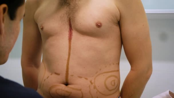 Um cirurgião plástico desenha uma marcação para a operação de lipoaspiração e lipossescultura. Um paciente é um homem, uma beleza de homem — Vídeo de Stock
