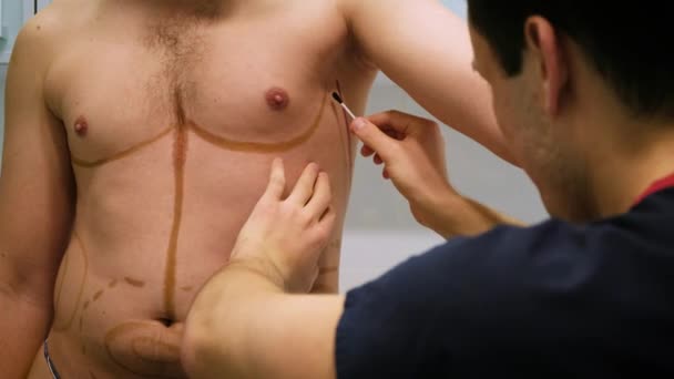 Een plastisch chirurg trekt een markering voor de werking van liposuctie en liposculptuur. Een patiënt is een man, een mans schoonheid — Stockvideo