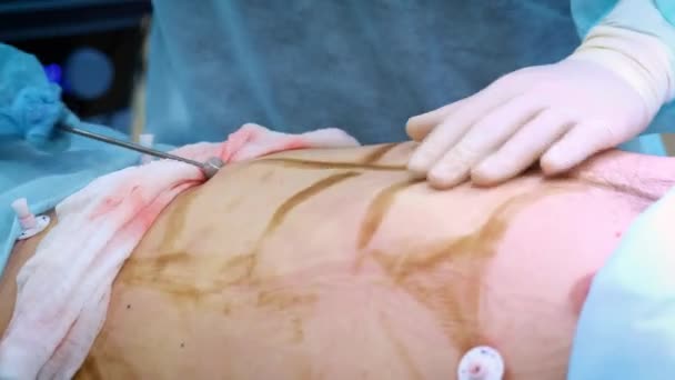 O médico realiza uma operação de lipoaspiração a um homem. Reúne a gordura da cânula. Cirurgia estética para um homem, melhoria do seu corpo . — Vídeo de Stock