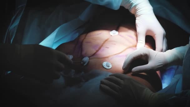 Χειρουργός και χειρουργική ομάδα εκτέλεση πλαστικής χειρουργικής επέμβασης στα στήθη σε λειτουργικό δωμάτιο νοσοκομείου. Αύξηση του μαστού. Διεύρυνση του μαστού. Η λιποαναρρόφηση. Περίθαλψης έκτακτης ανάγκης. Χειρουργική λεπτομέρεια. — Αρχείο Βίντεο