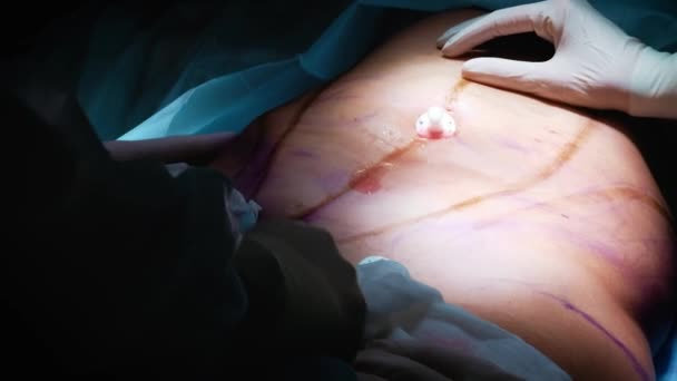 Chirurg i chirurgiczne zespołu są wykonywane w chirurgii plastycznej na piersi w sali operacyjnej szpitala. Powiększanie piersi. Powiększenie piersi. Liposukcja. Opieki w nagłych wypadkach. Szczegóły operacji. — Wideo stockowe