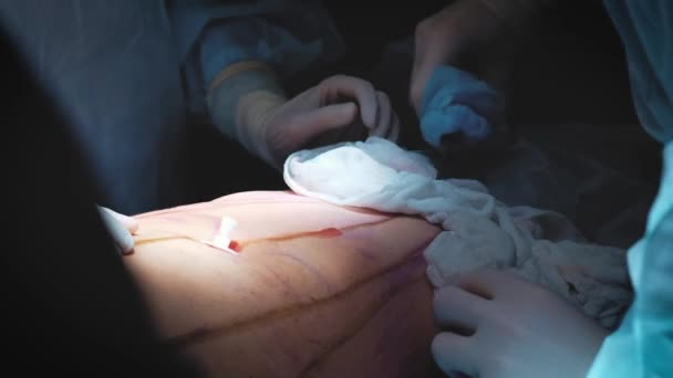 Tim bedah dan bedah melakukan operasi kosmetik pada payudara di ruang operasi rumah sakit. Peningkatan payudara. Perluasan payudara. Liposuction. Layanan darurat. Detil bedah . — Stok Video