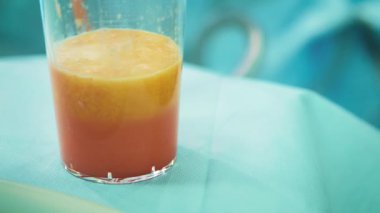 yağ ve yağ aldırma ameliyatı şişman Arayıcı. insan yağı liposuction sonra cam. Ameliyat sırasında fazla kalori drenaj